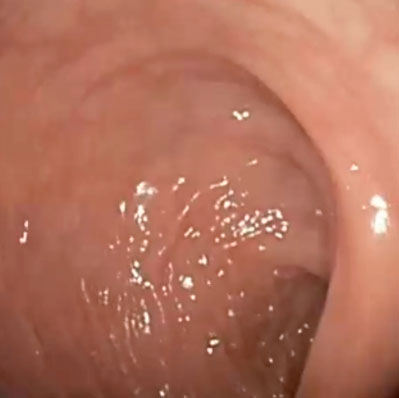 cleansing of the colon after